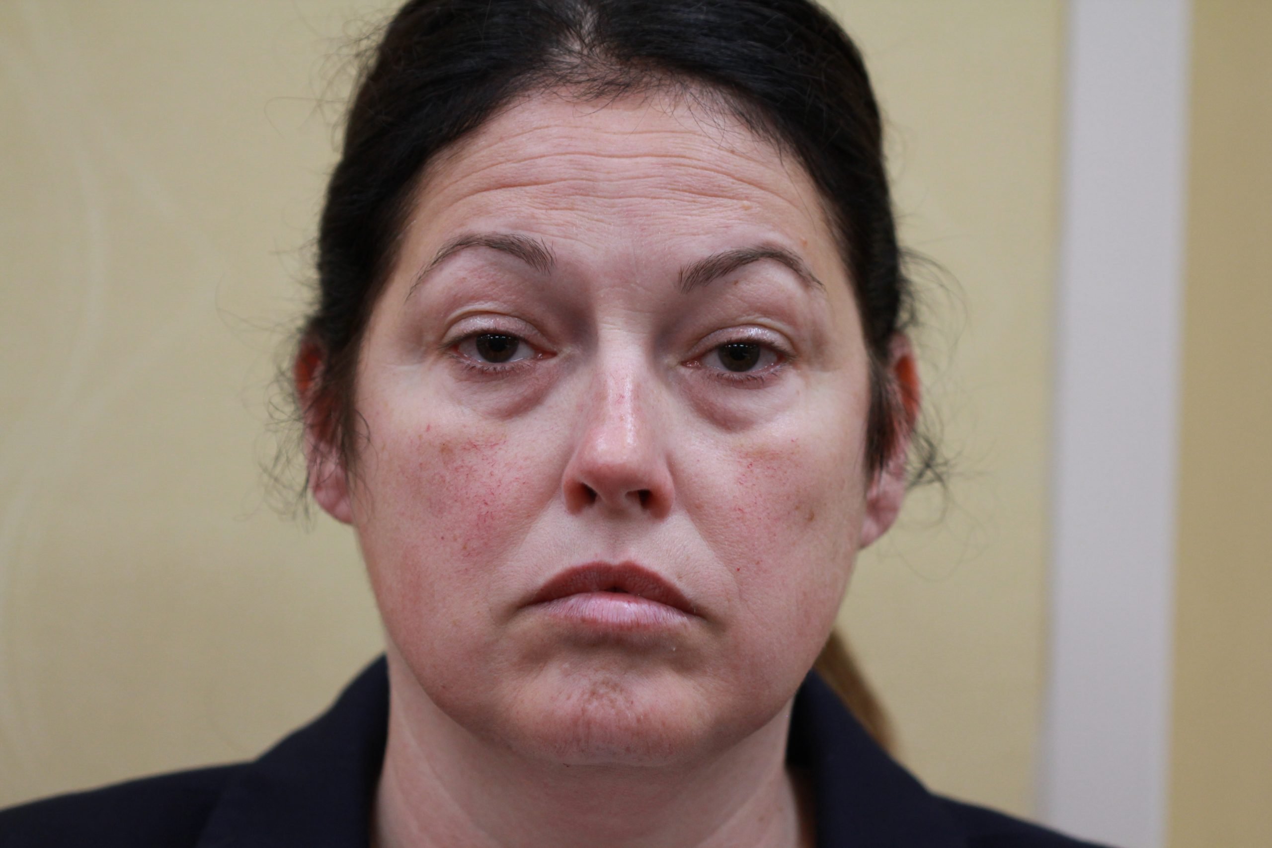 Stacy Before Microneedling with PRF