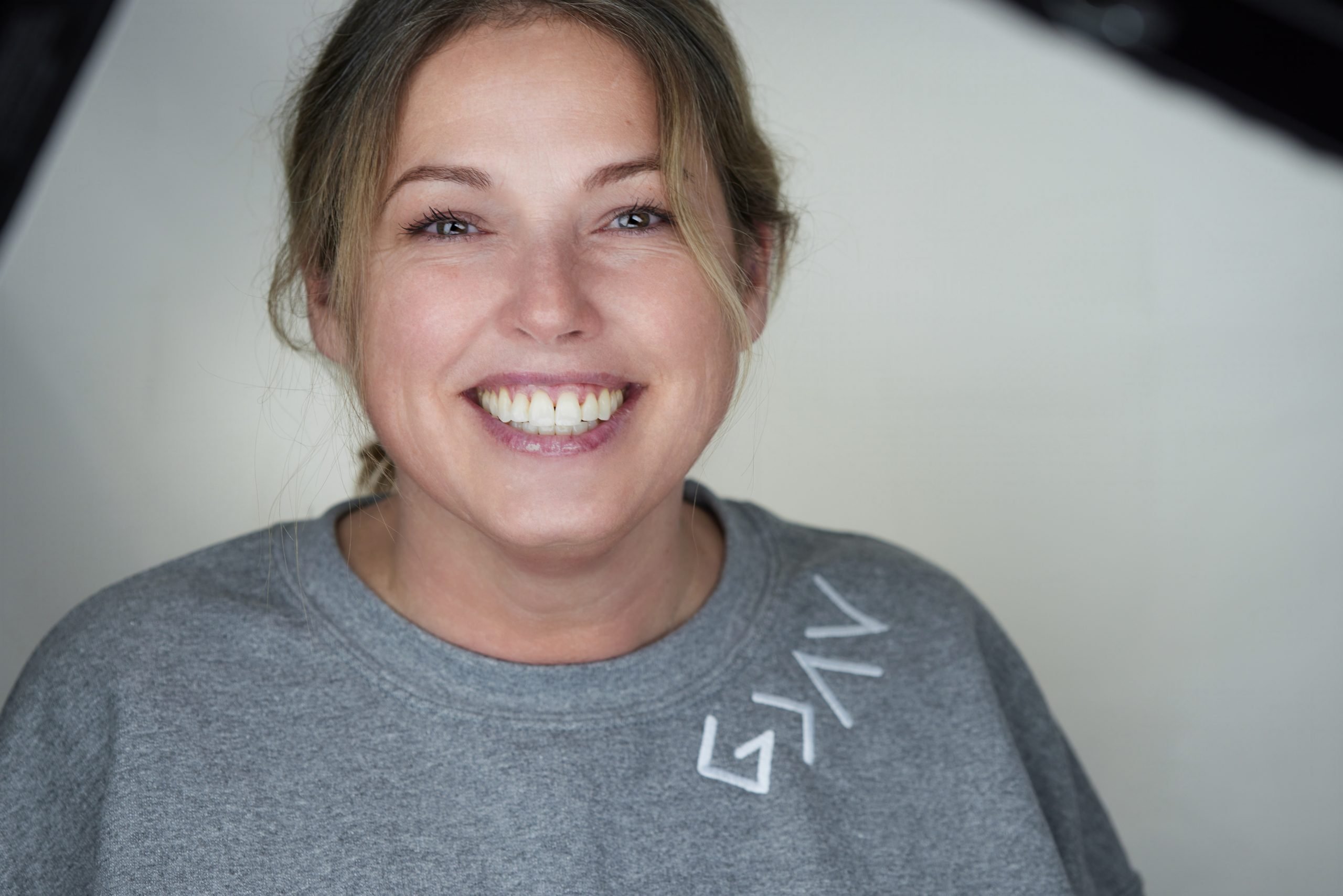 Stacy After Microneedling with PRF