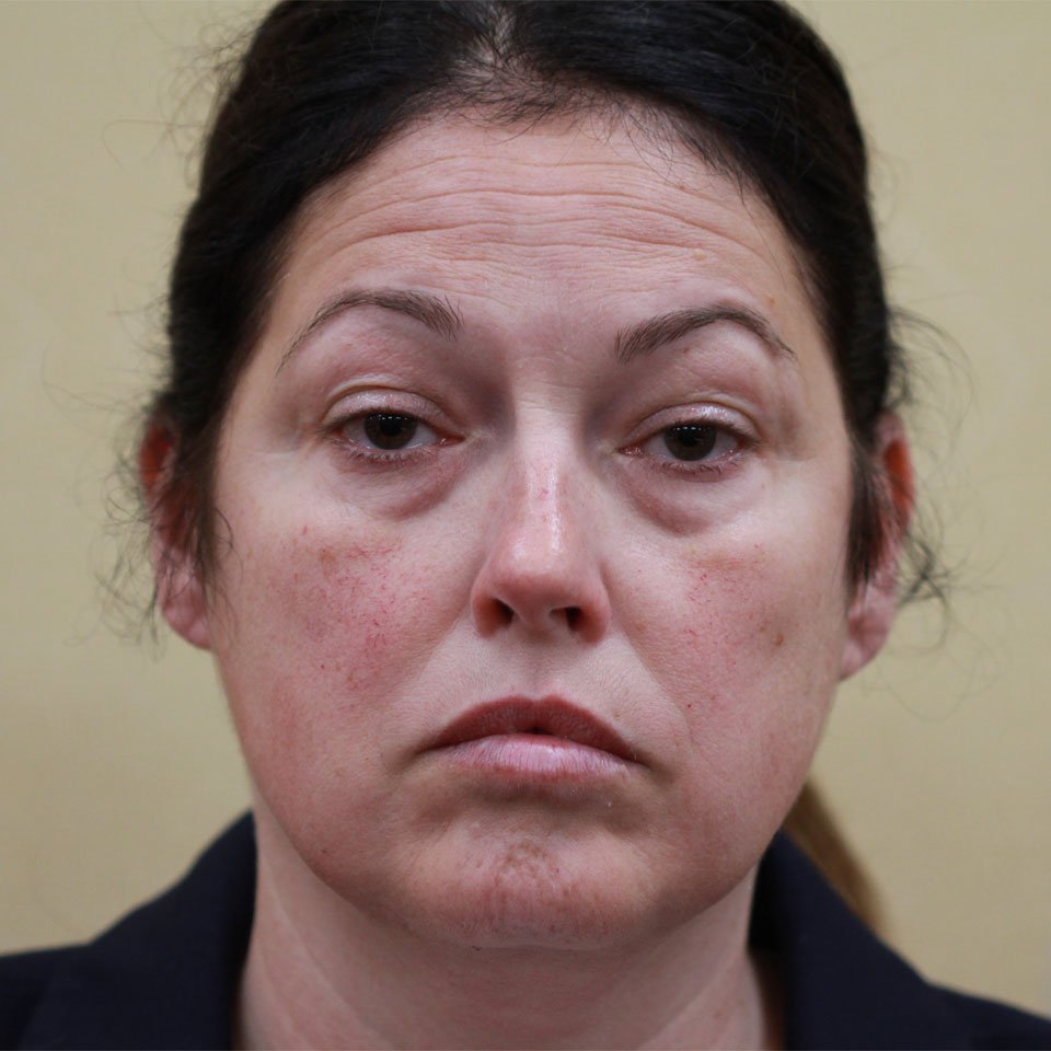 Non Surgical Facelift Patient Before