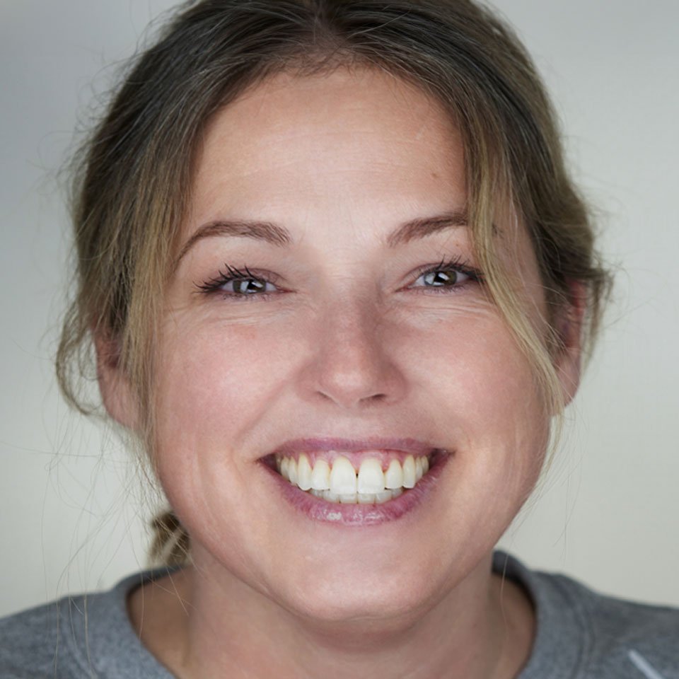 Non Surgical Facelift Patient After