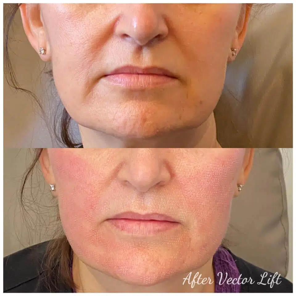 Non Surgical Facelift Patient Before and After Non Surgical Facelift, Bio-Lift