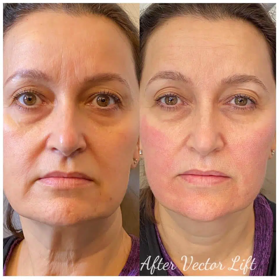 Non Surgical Facelift Patient Before and After Non Surgical Facelift, Bio-Lift