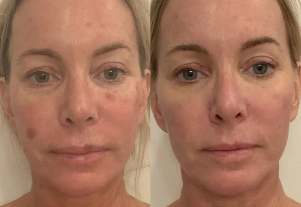 Skin Resurfacing Laser