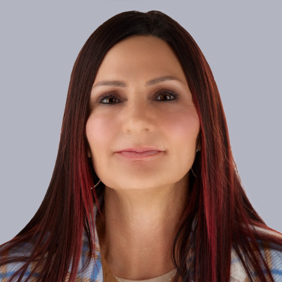 Non Surgical Facelift Before Picture