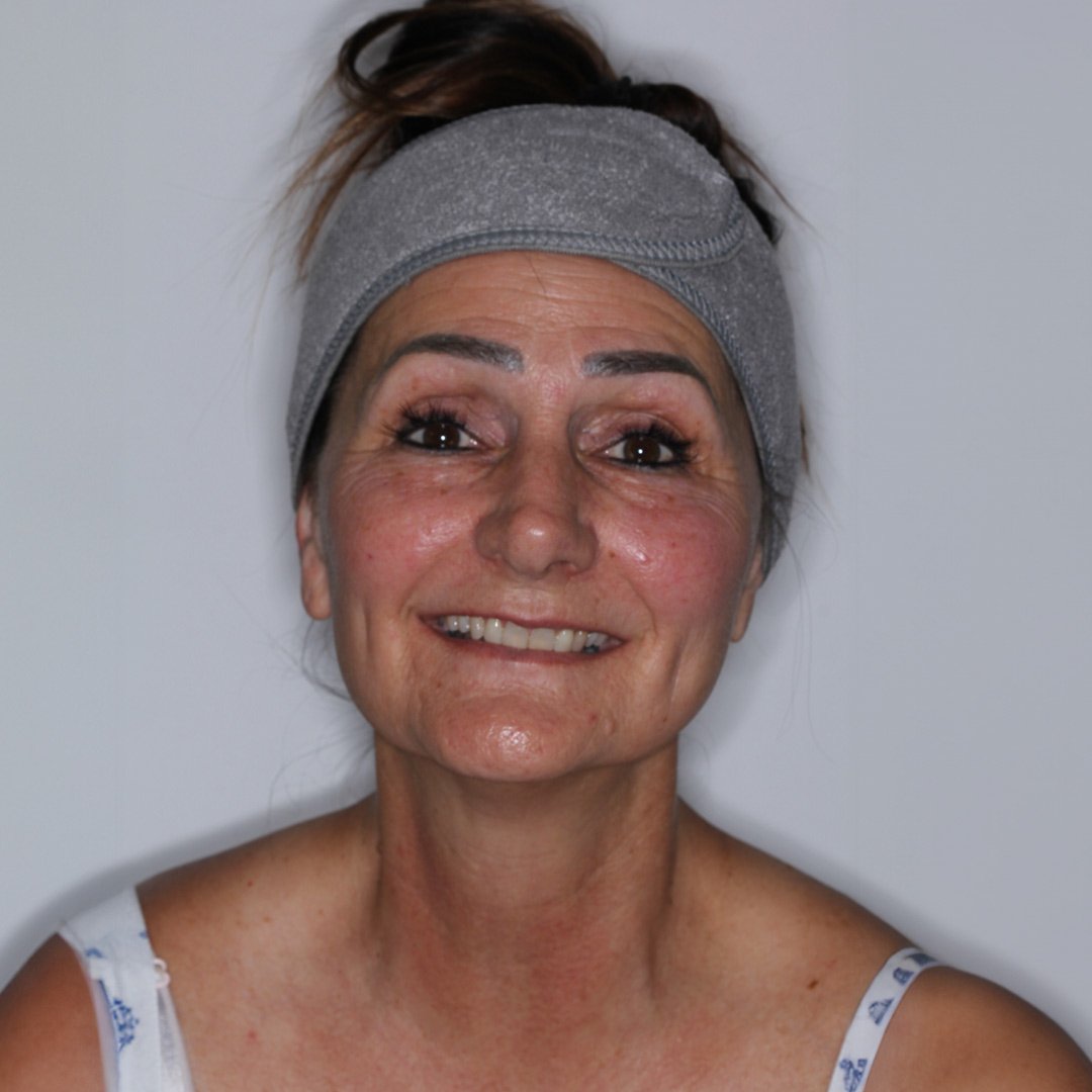 Non Surgical Facelift Before Picture