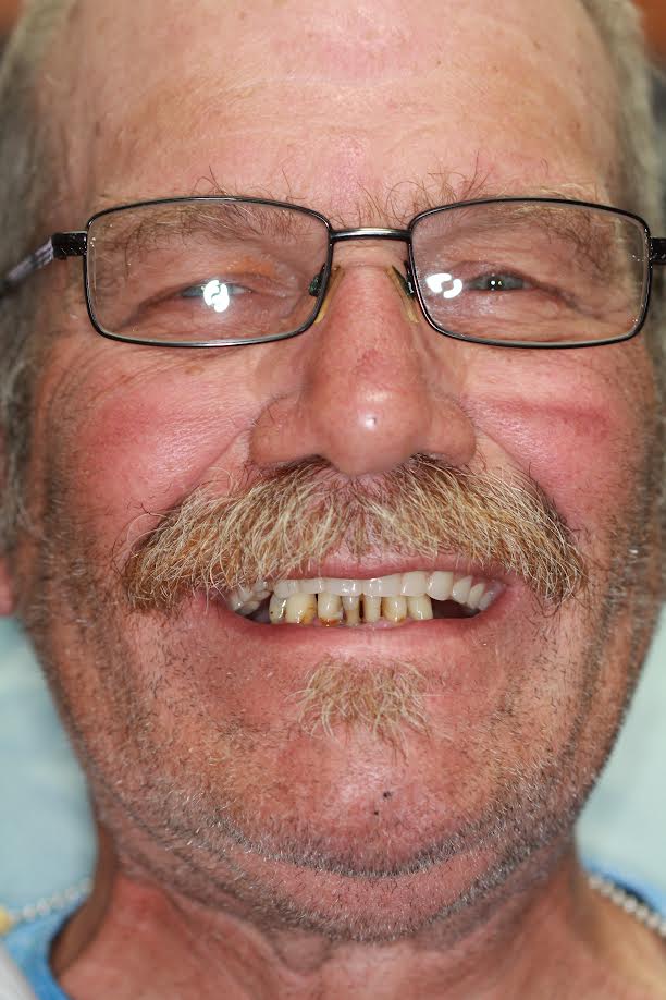 Functional Dentistry Patient Eric Before Photo