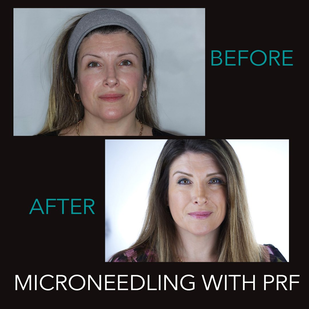 Microneedling with PRF Treatment Before and After Photos Microneedling with PFR Treatment Before and After Photos