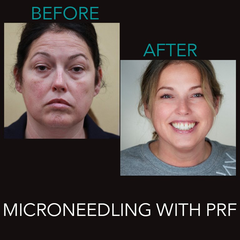 Prime Microneedling with PRF Treatment Before and After Photos Microneedling with PFR Treatment Before and After Photos