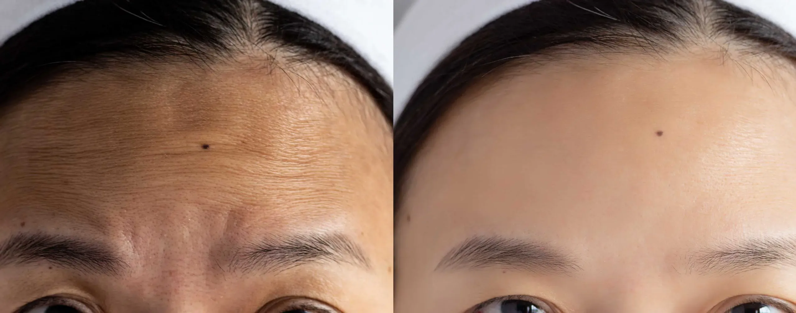 Botox Before and After Before and After PRF Treatment Pictures