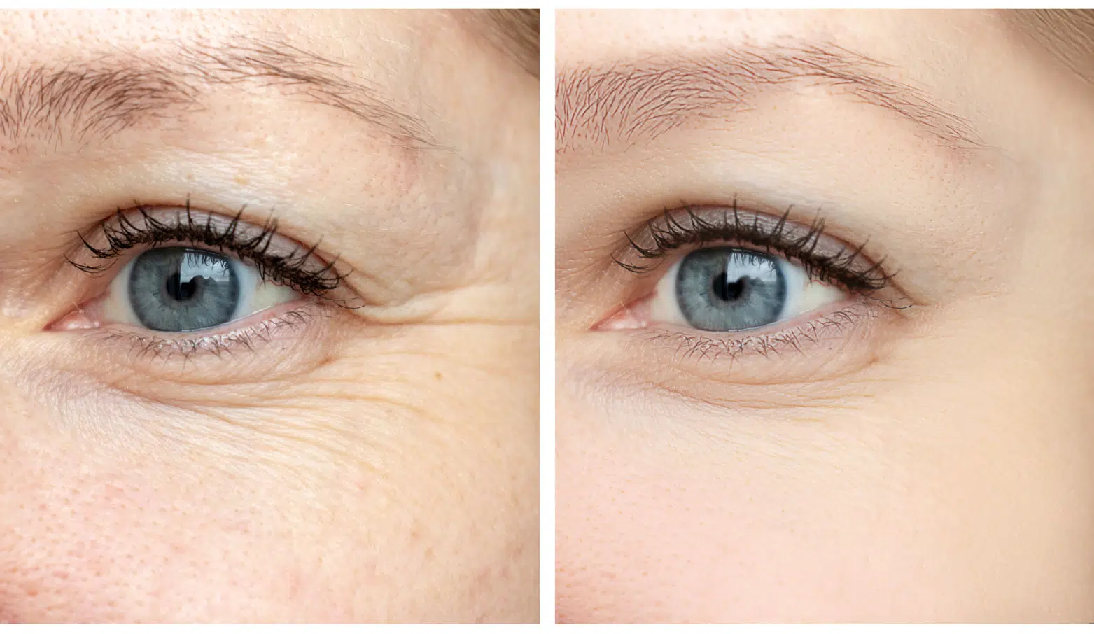 Botox Before and After