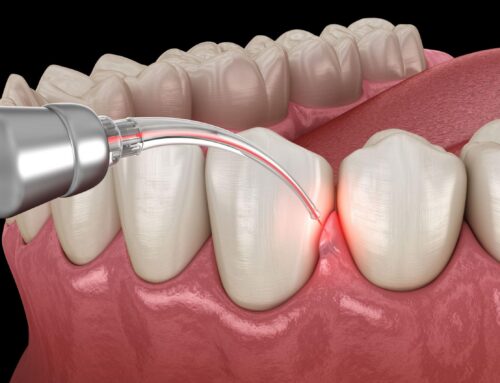 Laser Dentistry: The Future of Dental Care