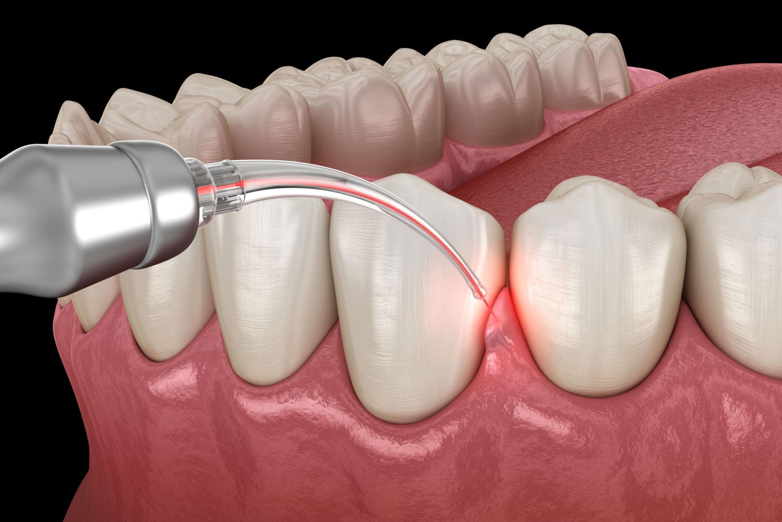 laser dentistry in Moline, IL